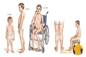 دیستروفی عضلانی چیست؟ علائم تشخیص و درمان