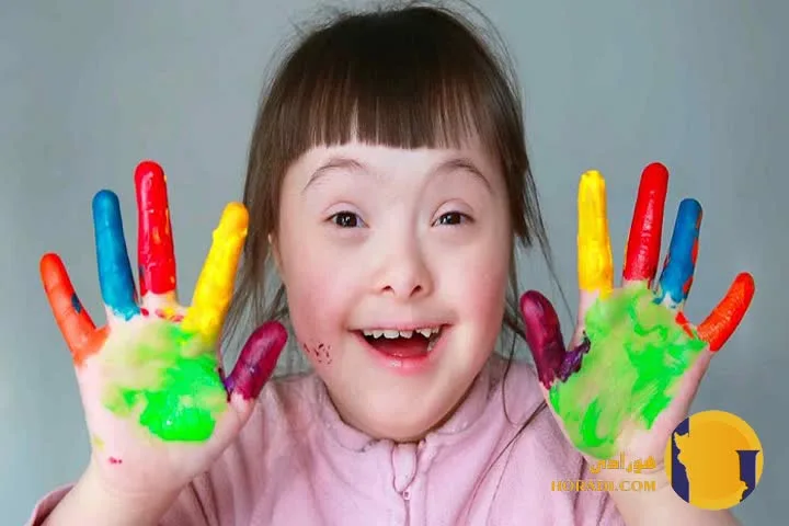 سندرم داون چیست؟ علائم و روش های مراقبت