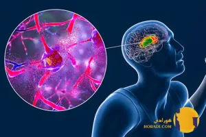 بیماری هانتینگتون چیست؟ علائم و درمان