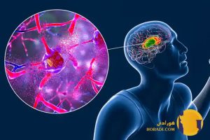 بیماری هانتینگتون چیست؟ علائم و درمان