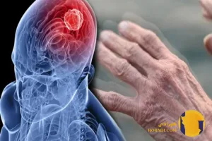 بیماری پارکینسون چیست؟ علائم تشخیص و درمان