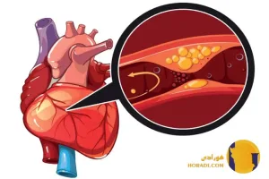 آنژین صدری چیست؟ علائم علت ها و درمان