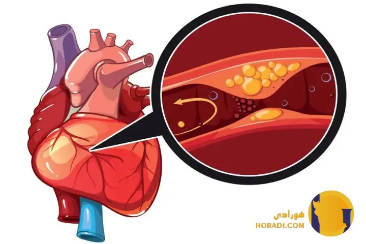 آنژین صدری چیست؟ علائم علت ها و درمان