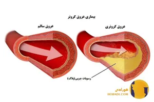 بیماری عروق کرونر چیست؟ علائم و پیشگیری
