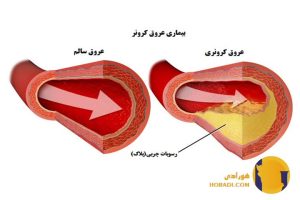 بیماری عروق کرونر چیست؟ علائم و پیشگیری