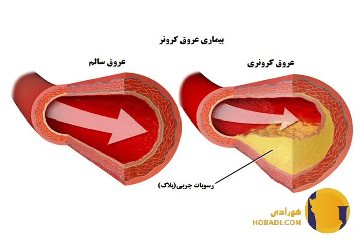 بیماری عروق کرونر چیست؟ علائم و پیشگیری