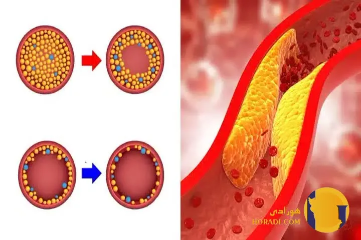 کلسترول بالا چیست؟ علائم عوارض و کنترل
