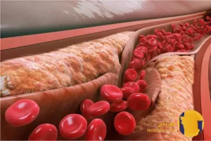 چربی خون بالا چیست؟ علائم و روش های کاهش