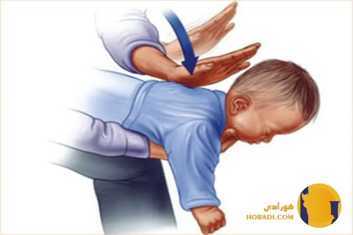 کمک های اولیه برای خفگی و انسداد راه هوایی