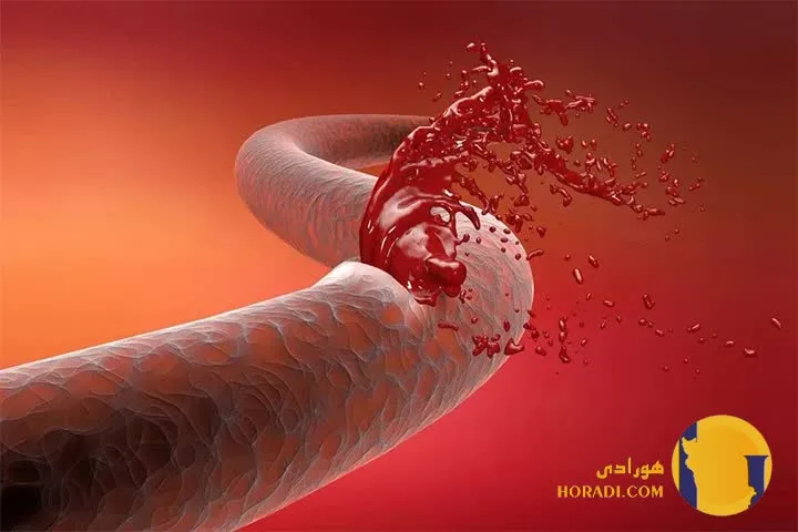 نحوه کنترل خونریزی شدید