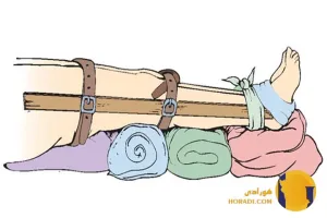 اقدامات اورژانسی در شکستگی ها و دررفتگی ه