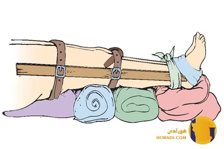 اقدامات اورژانسی در شکستگی ها و دررفتگی ه