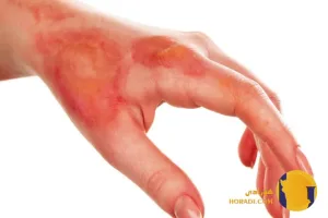 کمک های اولیه برای سوختگی ها و تاول های حرارتی