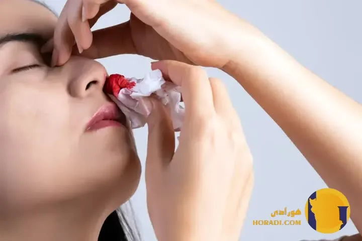 اقدامات اورژانسی برای خون دماغ شدید