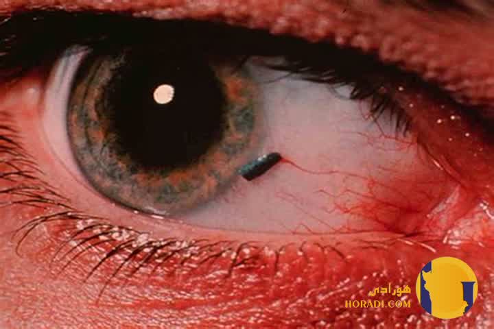 کمک های فوری در وارد شدن اجسام خارجی به چشم