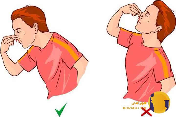 اقدامات اورژانسی برای خونریزی بینی شدید