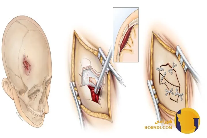 کمک فوری در شکستگی جمجمه و ضربه به سر