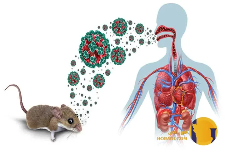 هانتاویروس (Hantavirus infection)